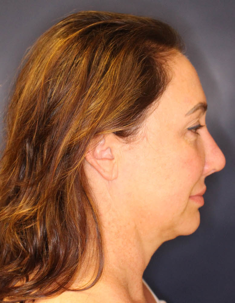 Face & Neck Lift Before & After Image