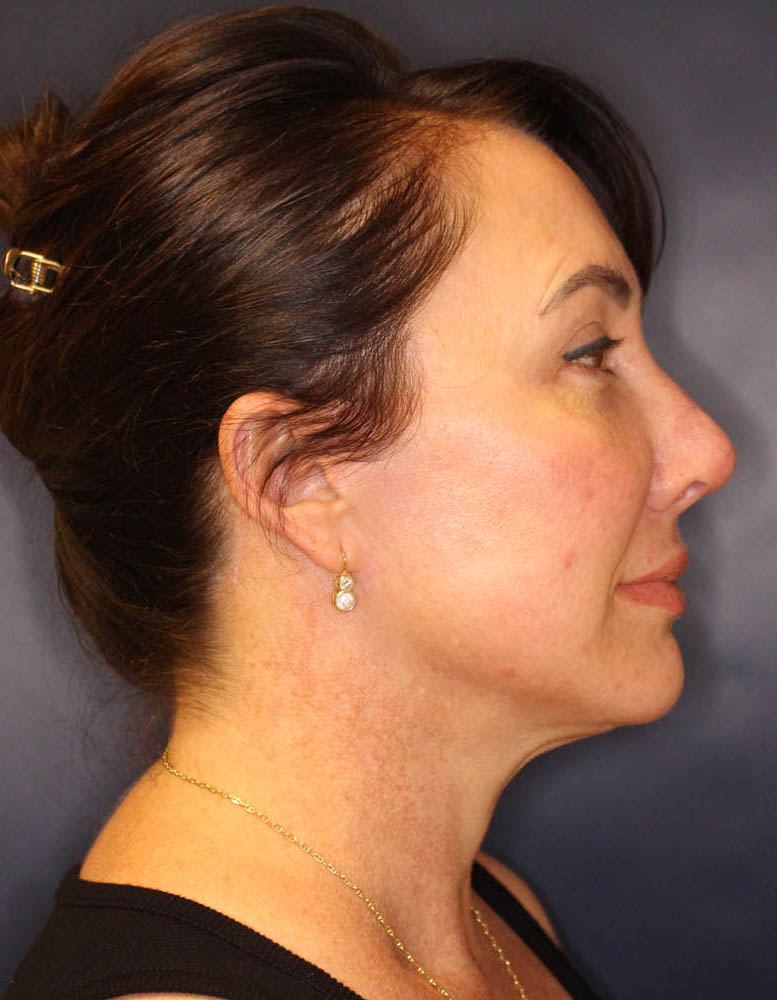 Face & Neck Lift Before & After Image