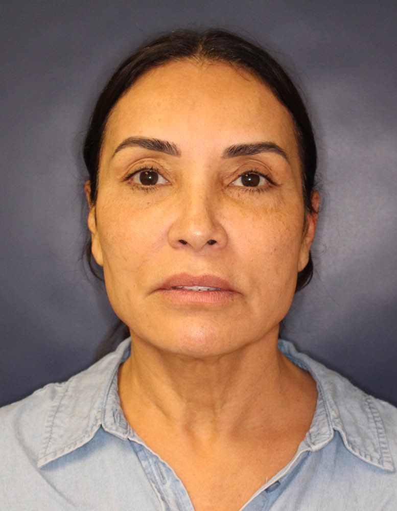 Face & Neck Lift Before & After Image