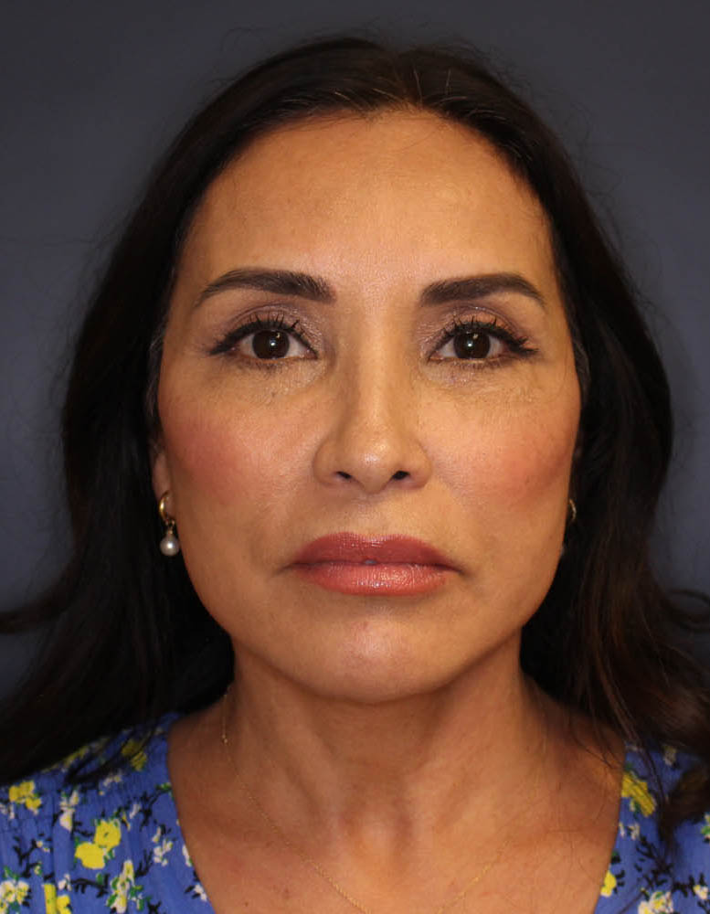 Face & Neck Lift Before & After Image