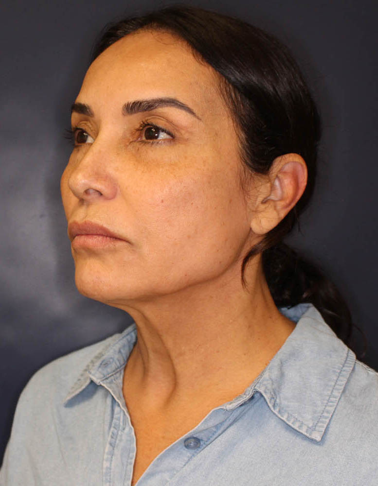 Face & Neck Lift Before & After Image