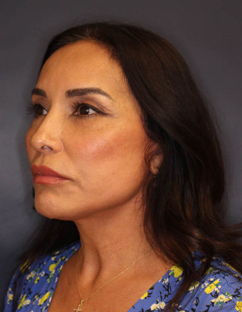 Face & Neck Lift Before & After Image