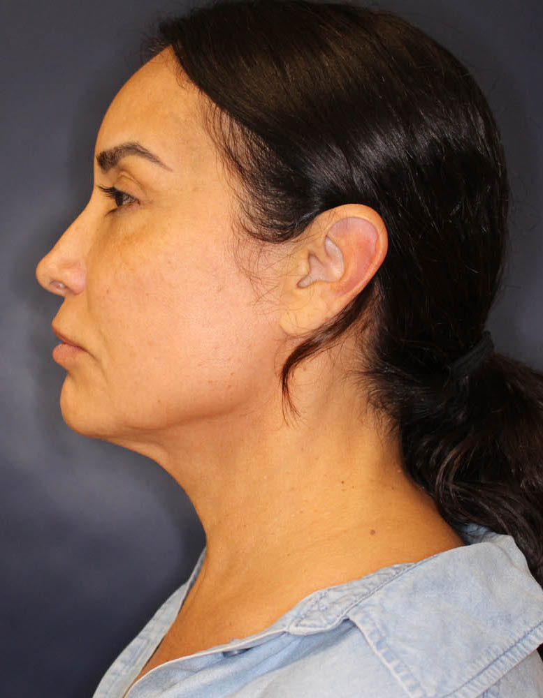 Face & Neck Lift Before & After Image