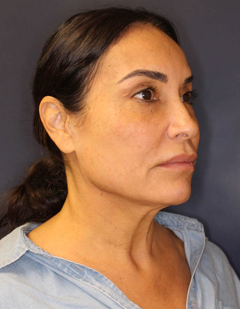 Face & Neck Lift Before & After Image