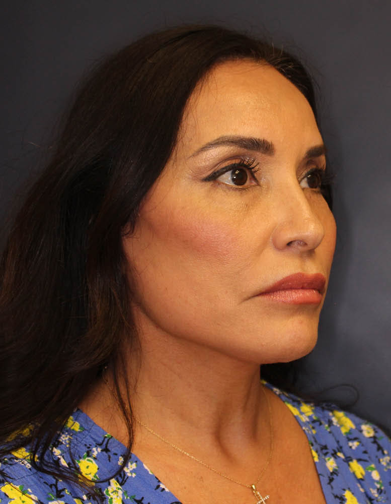 Face & Neck Lift Before & After Image