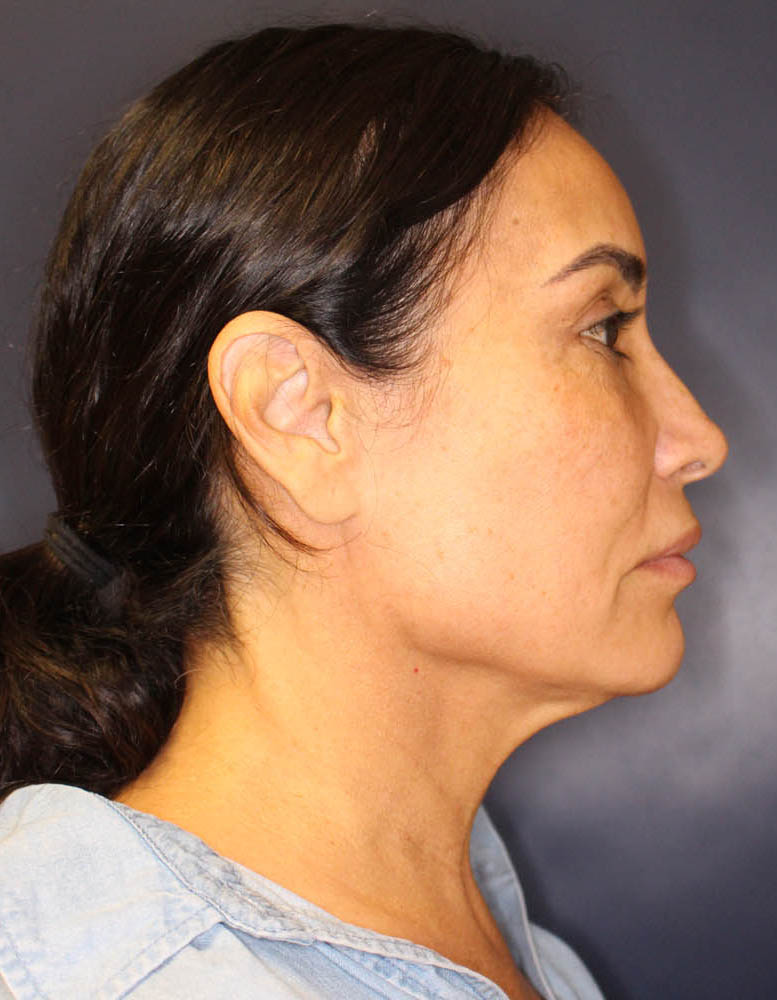 Face & Neck Lift Before & After Image