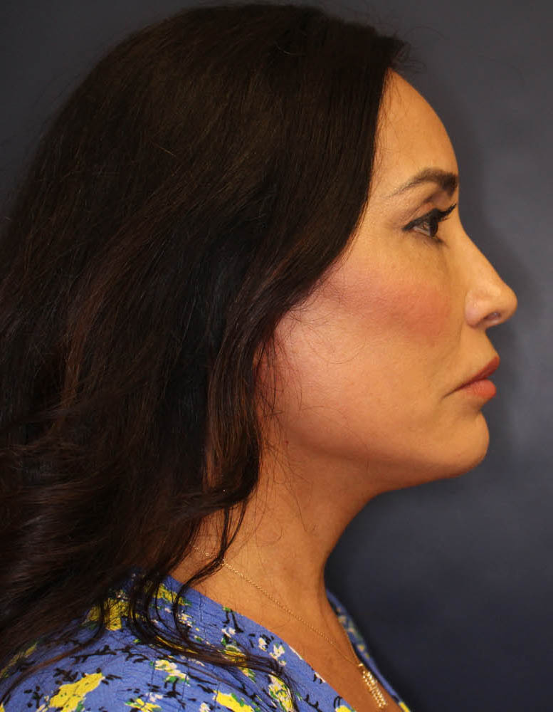 Face & Neck Lift Before & After Image