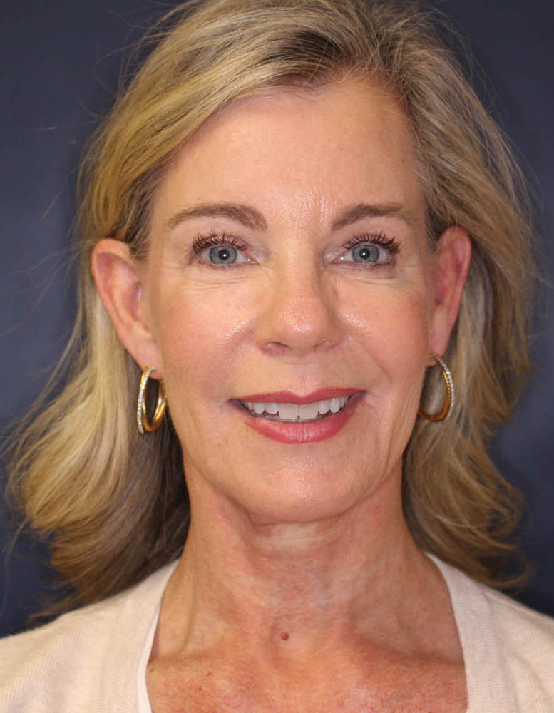 Face & Neck Lift Before & After Image