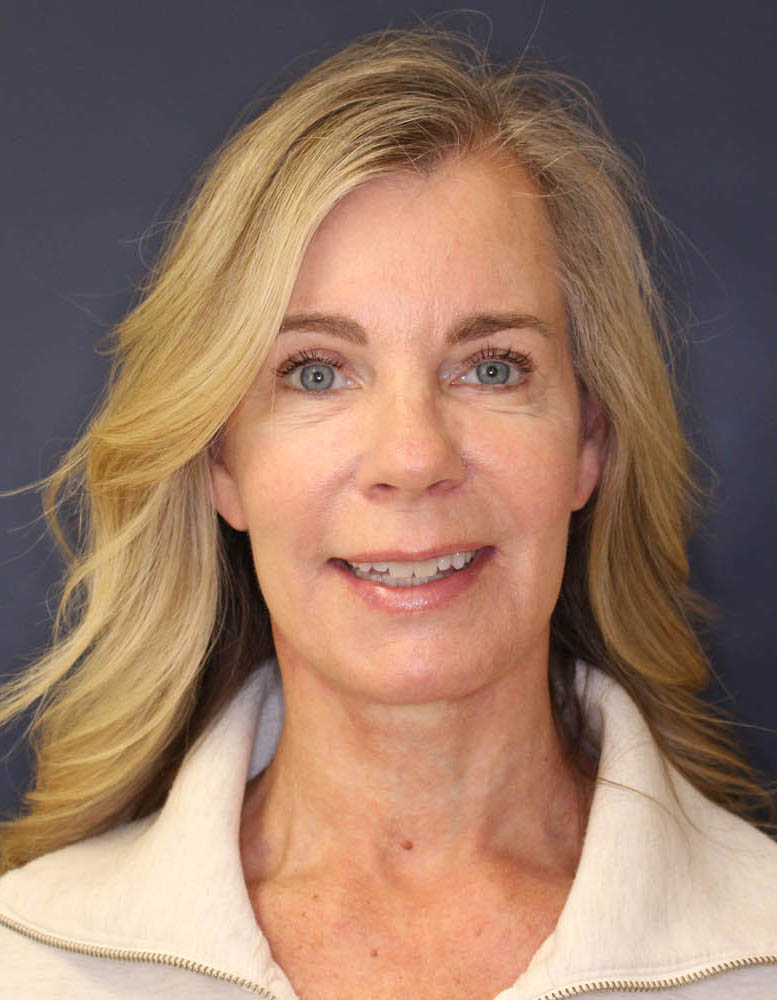 Face & Neck Lift Before & After Image