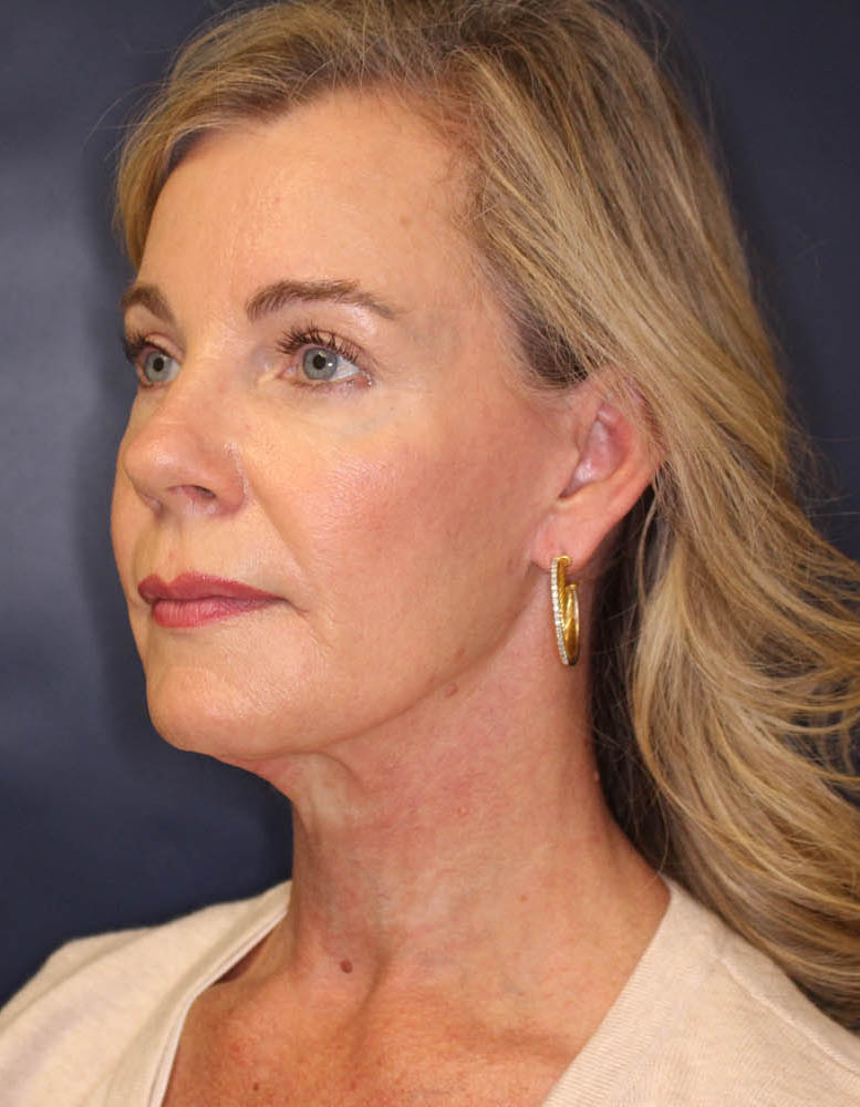 Face & Neck Lift Before & After Image