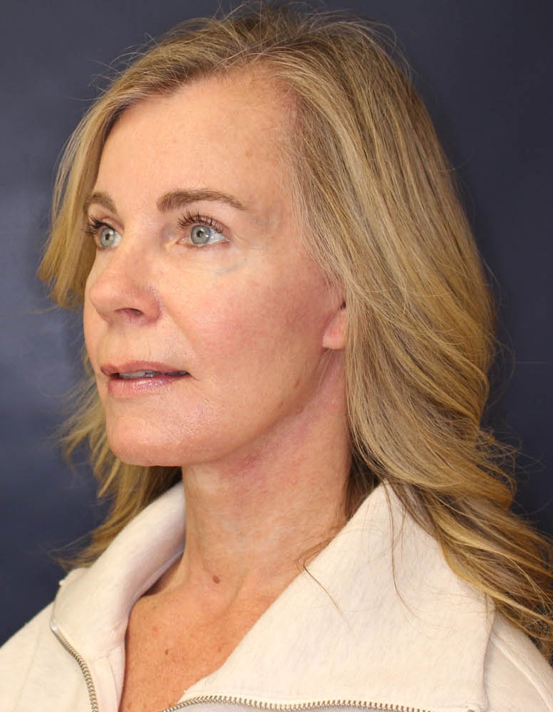Face & Neck Lift Before & After Image