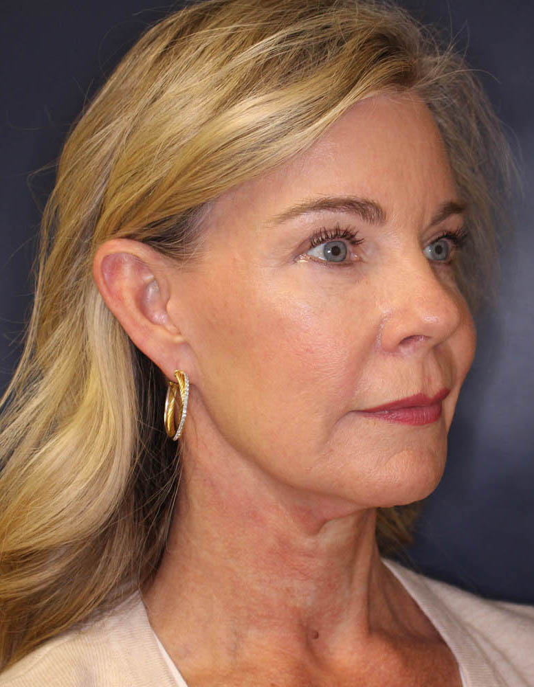 Face & Neck Lift Before & After Image