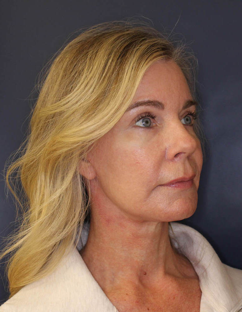 Face & Neck Lift Before & After Image