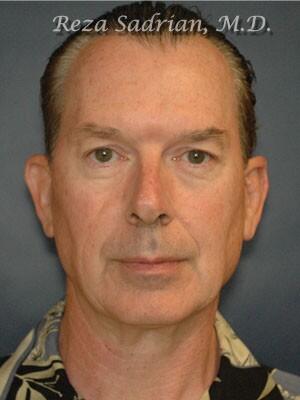 Facial Plastic Surgery for Men Before & After Image