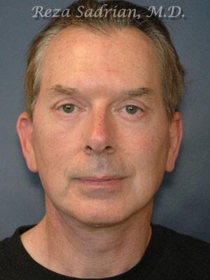 Facial Plastic Surgery for Men Before & After Image