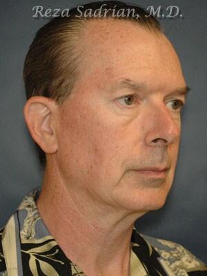 Facial Plastic Surgery for Men Before & After Image
