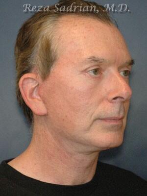 Facial Plastic Surgery for Men Before & After Image