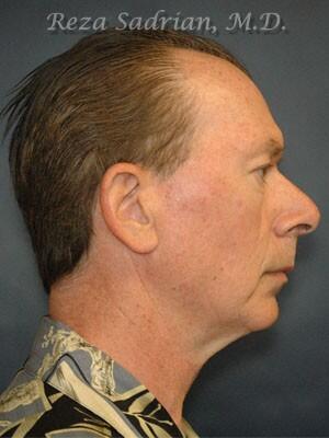 Facial Plastic Surgery for Men Before & After Image