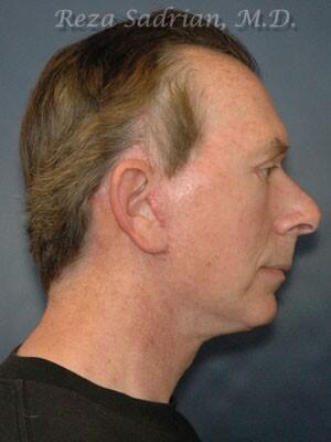 Facial Plastic Surgery for Men Before & After Image