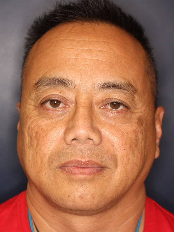 Facial Plastic Surgery for Men Before & After Image