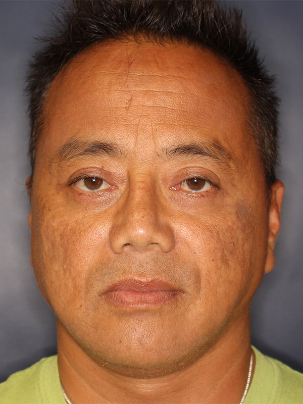 Facial Plastic Surgery for Men Before & After Image