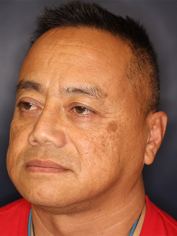 Facial Plastic Surgery for Men Before & After Image