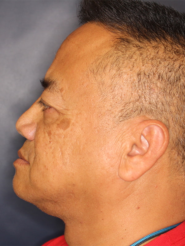 Facial Plastic Surgery for Men Before & After Image