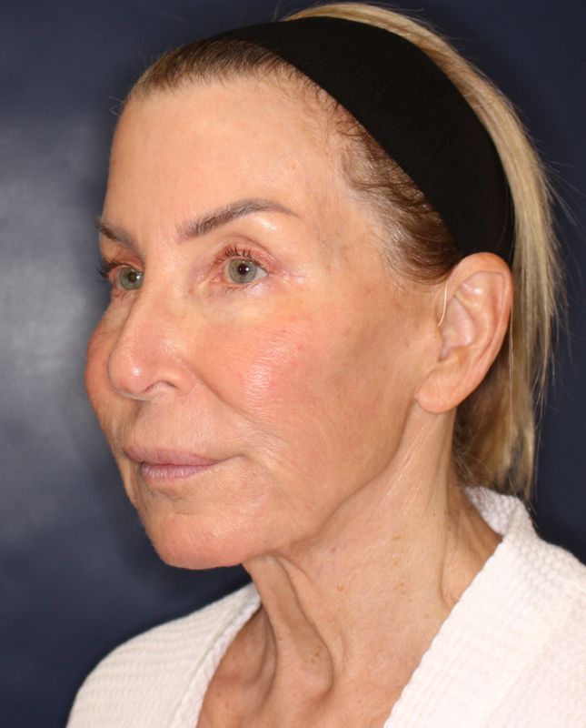 Fat Grafting Before & After Image