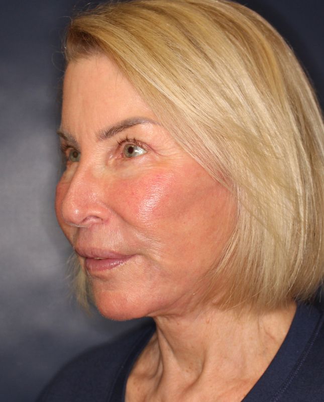 Fat Grafting Before & After Image