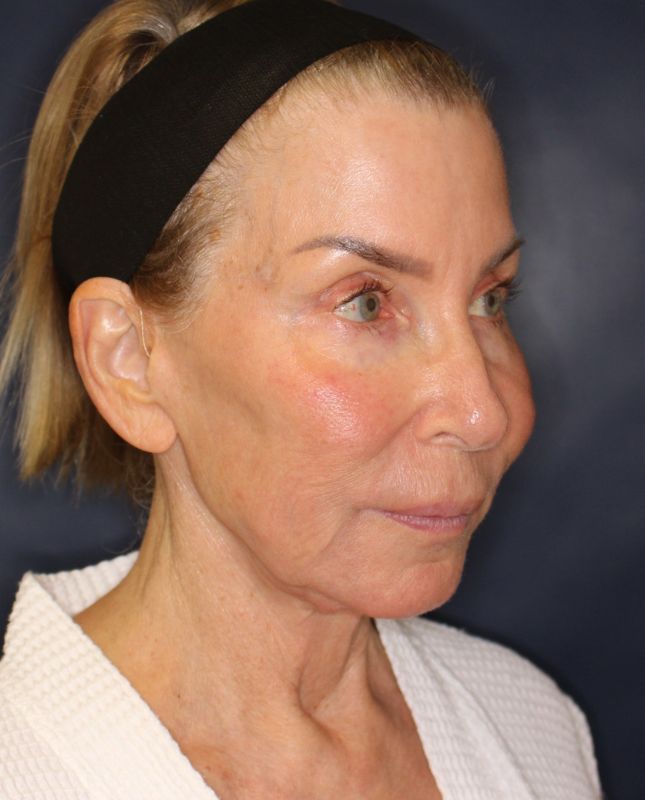 Fat Grafting Before & After Image