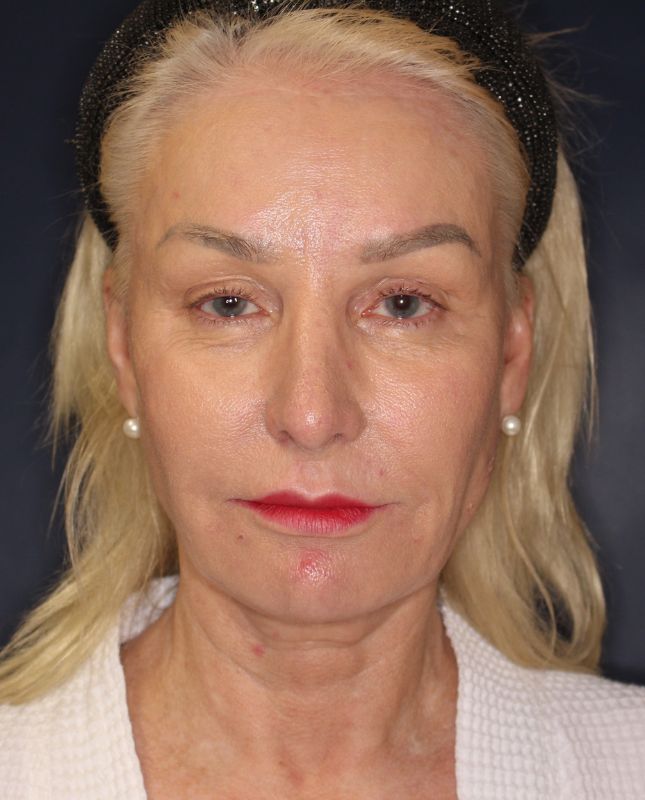 Fat Grafting Before & After Image