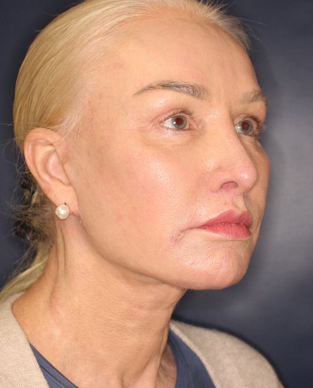 Fat Grafting Before & After Image