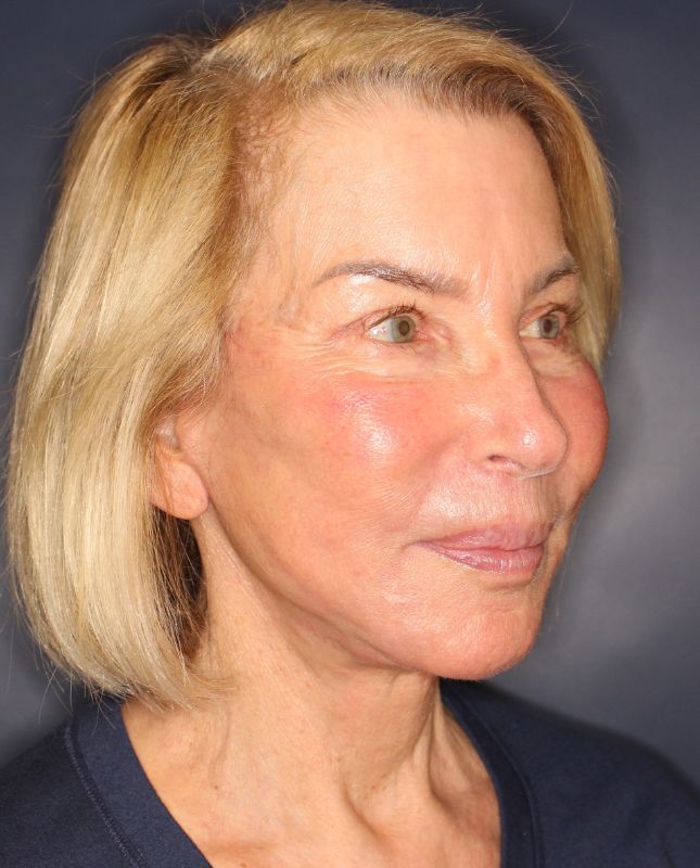 Lip Lift Before & After Image
