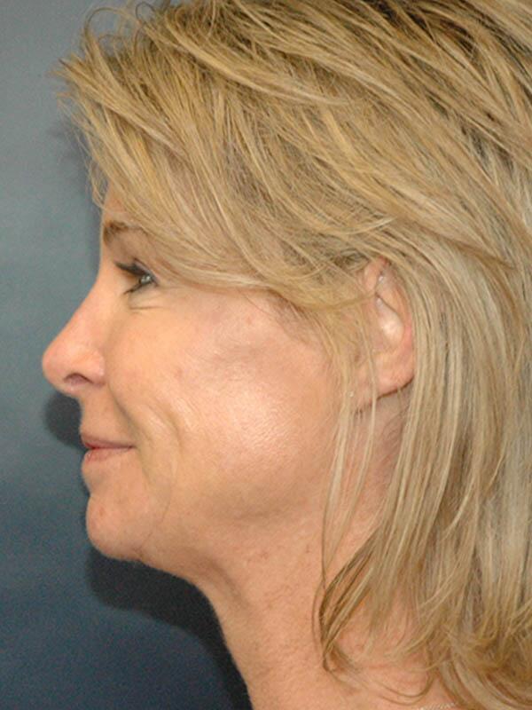 Nose Reshaping Before & After Image