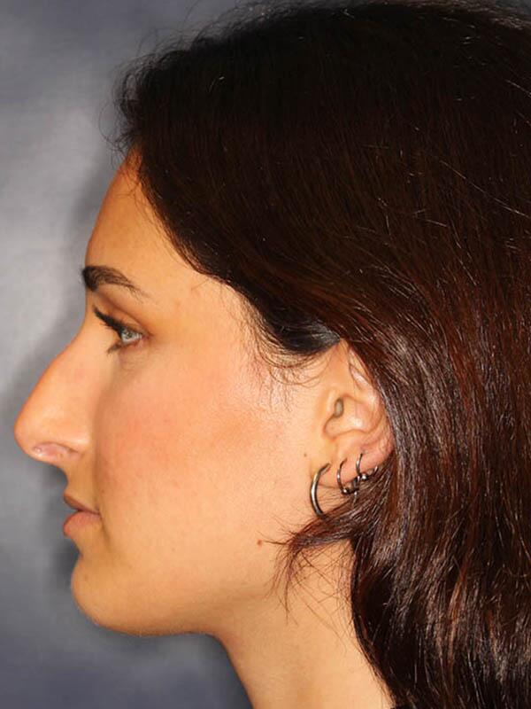 Nose Reshaping Before & After Image