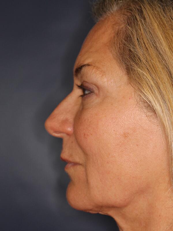 Nose Reshaping Before & After Image