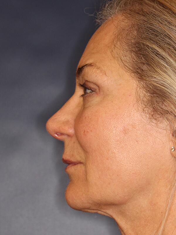 Nose Reshaping Before & After Image