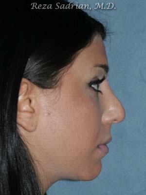 Nose Reshaping Before & After Image