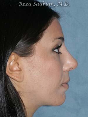 Nose Reshaping Before & After Image