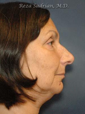 Nose Reshaping Before & After Image