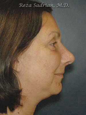 Nose Reshaping Before & After Image