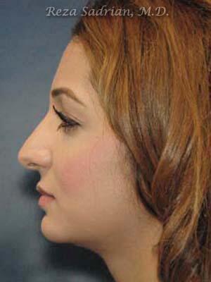 Nose Reshaping Before & After Image