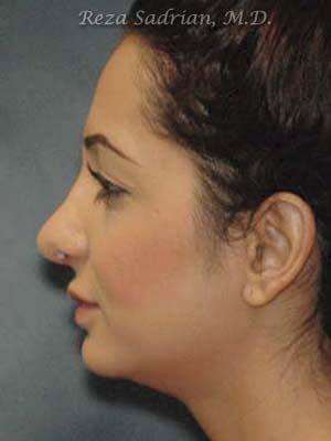 Nose Reshaping Before & After Image