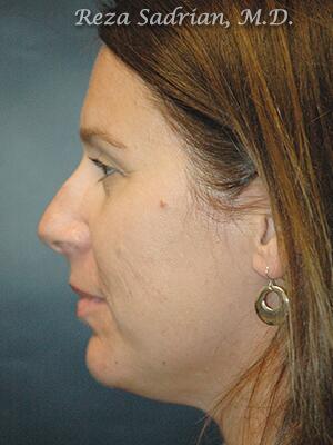 Nose Reshaping Before & After Image