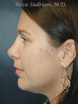 Nose Reshaping Before & After Image