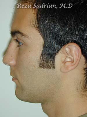 Nose Reshaping Before & After Image