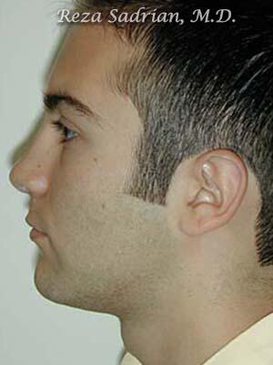 Nose Reshaping Before & After Image