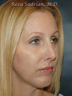 Nose Reshaping Before & After Image