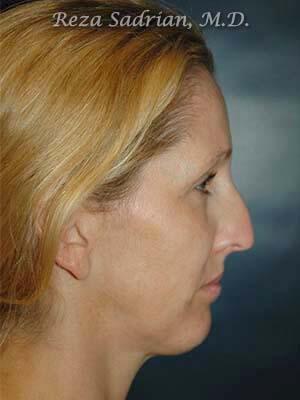 Nose Reshaping Before & After Image