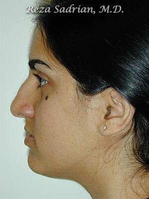 Nose Reshaping Before & After Image